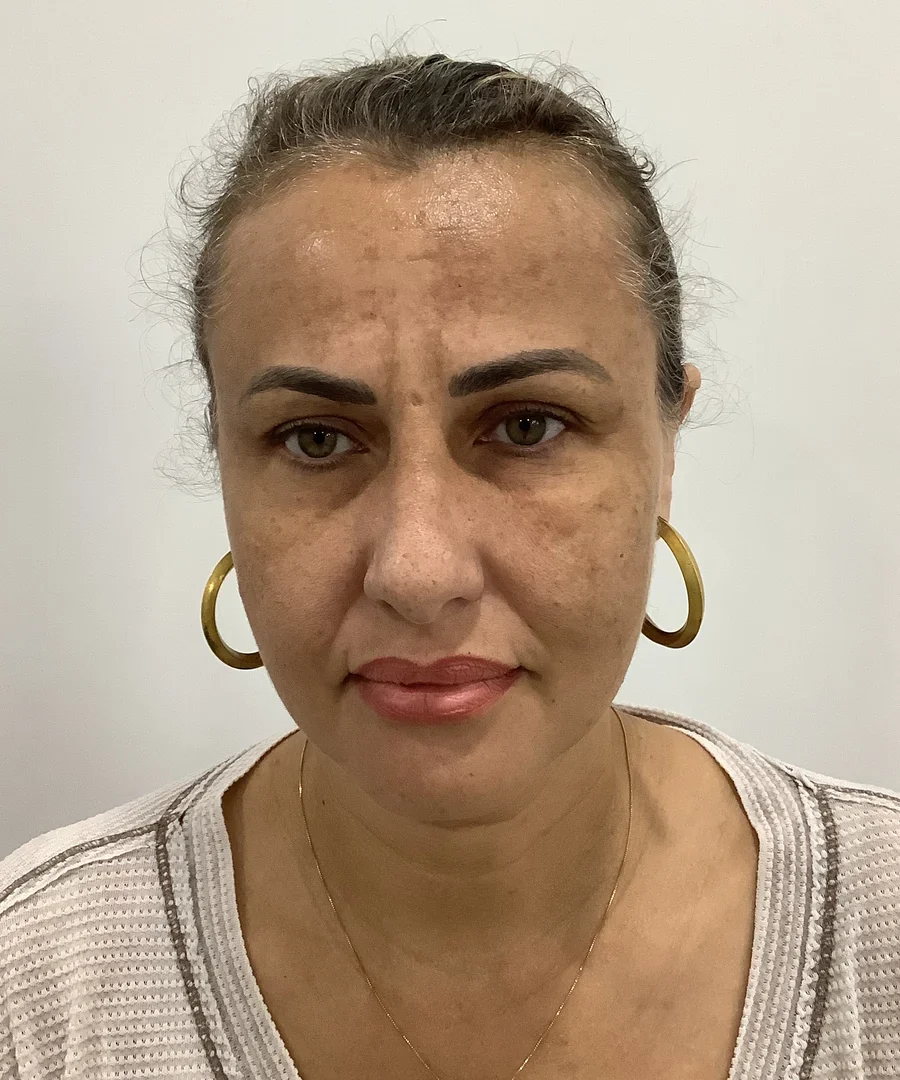 Fotona Melasma Treatment, before treatment